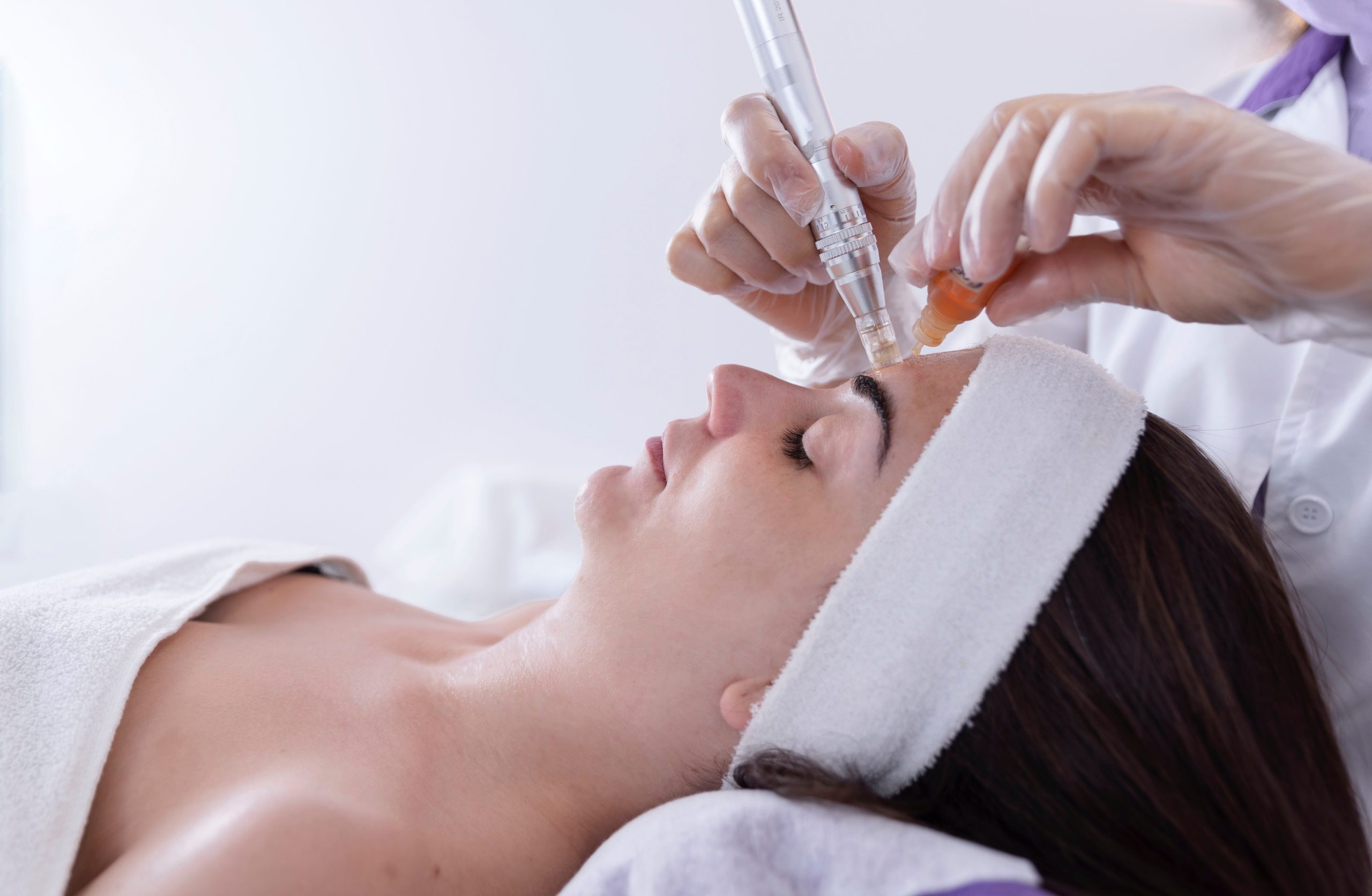 Microneedling-y-Exosomas-valencia-scaled